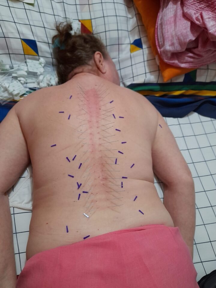 acupuntura para el dolor de espalda, Dr Christian Diaz